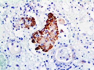 IHC of C3d on a FFPE Rejected Kidney Transplant Tissue